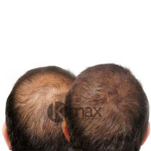 kmax_head2_hair_fibers_2_2_1